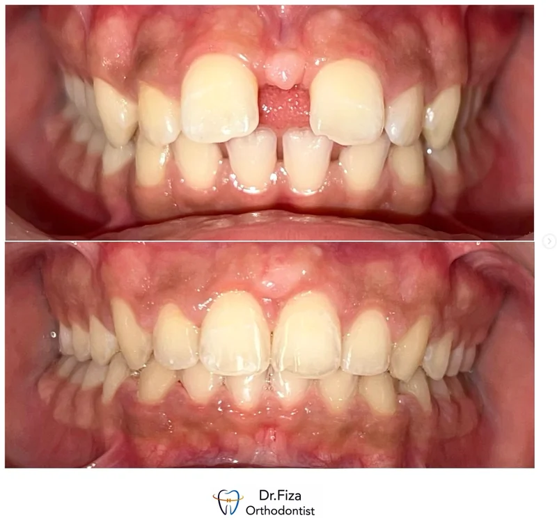 Intraoral orthodontic record 1 by Dr. Fiza Quadri. Before treatment above and after treatment below.