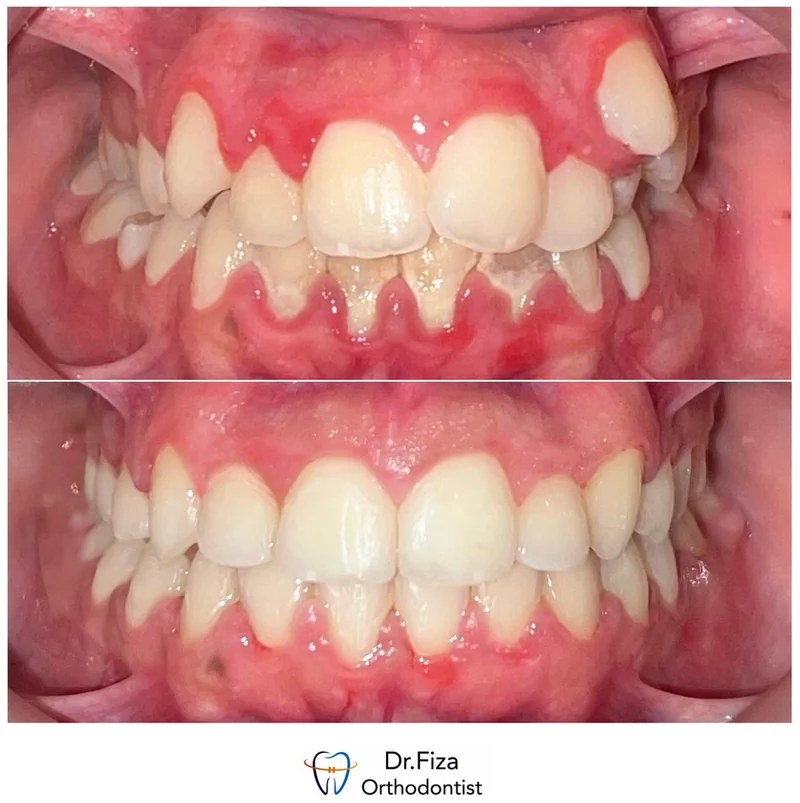 Intraoral orthodontic record 2 by Dr. Fiza Quadri. Before treatment above and after treatment below.