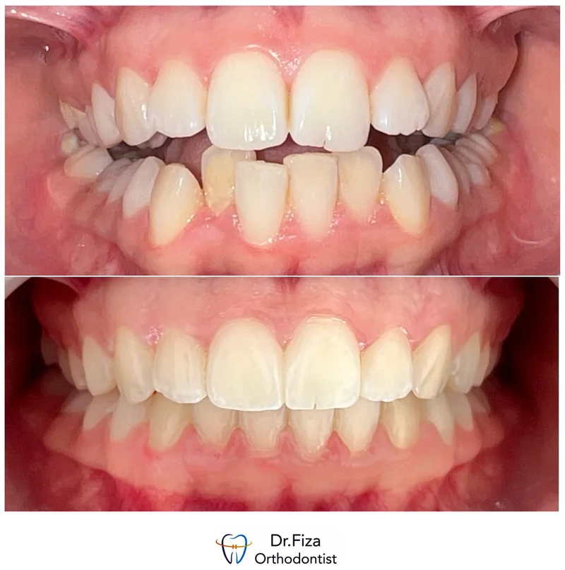 Intraoral orthodontic record 3 by Dr. Fiza Quadri. Before treatment above and after treatment below.