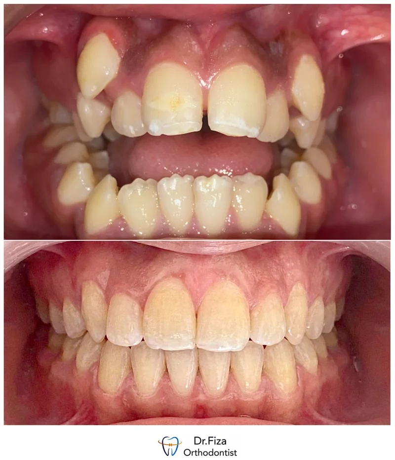 Intraoral orthodontic record 4 by Dr. Fiza Quadri. Before treatment above and after treatment below.