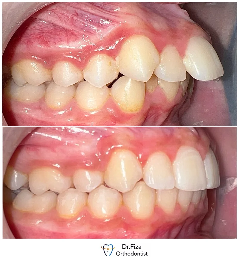 Intraoral orthodontic record 5 by Dr. Fiza Quadri. Before treatment above and after treatment below.