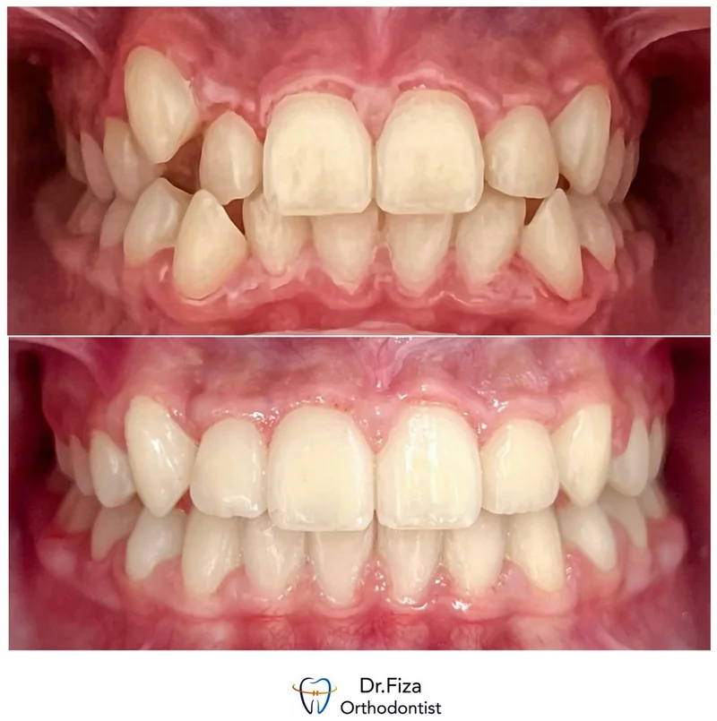 Intraoral orthodontic record 6 by Dr. Fiza Quadri. Before treatment above and after treatment below.