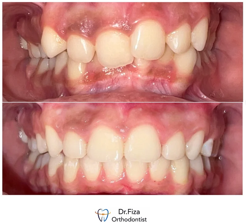 Intraoral orthodontic record 7 by Dr. Fiza Quadri. Before treatment above and after treatment below.