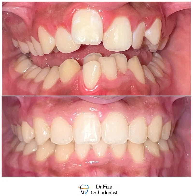 Intraoral orthodontic record 8 by Dr. Fiza Quadri. Before treatment above and after treatment below.