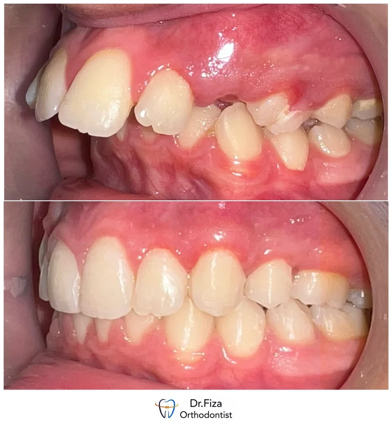 Intraoral orthodontic record 9 by Dr. Fiza Quadri. Before treatment above and after treatment below.