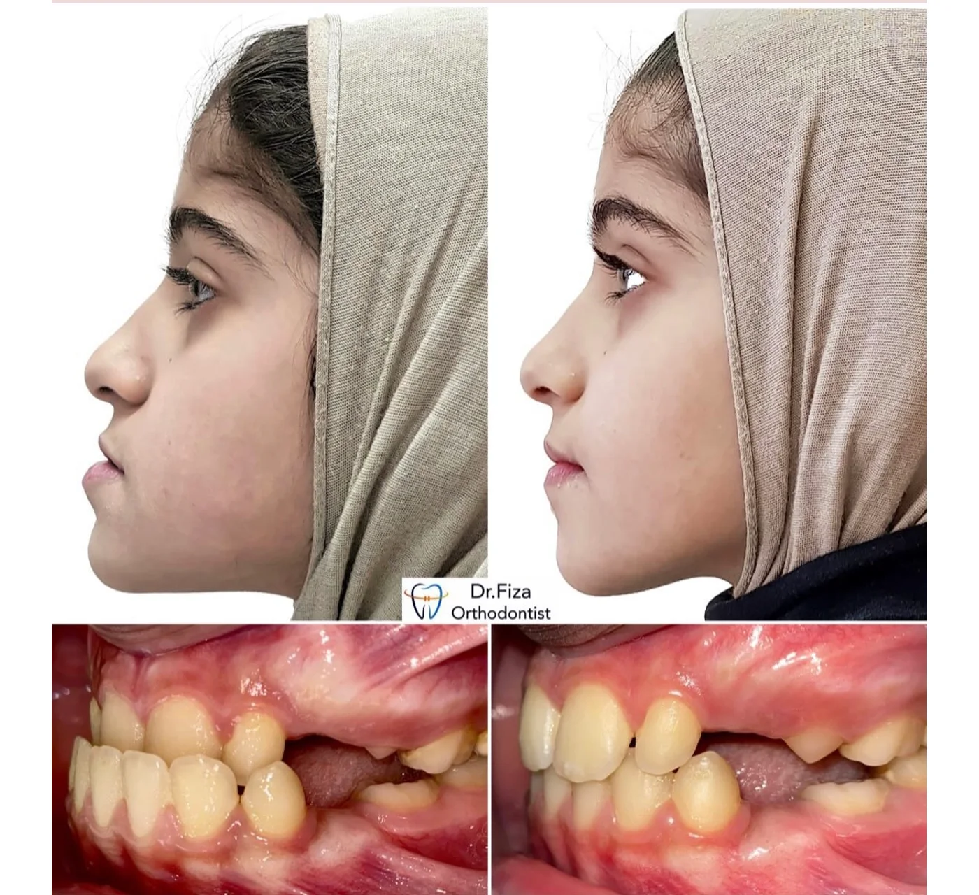 Orthodontic before and after by Dr. Fiza Quadri in Kuwait: jaw corrections
