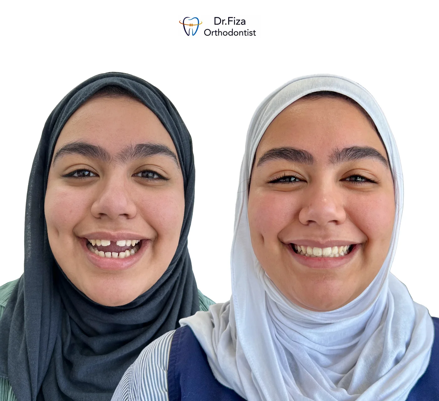 Orthodontic before and after by Dr. Fiza Quadri in Kuwait: spacing between teeth