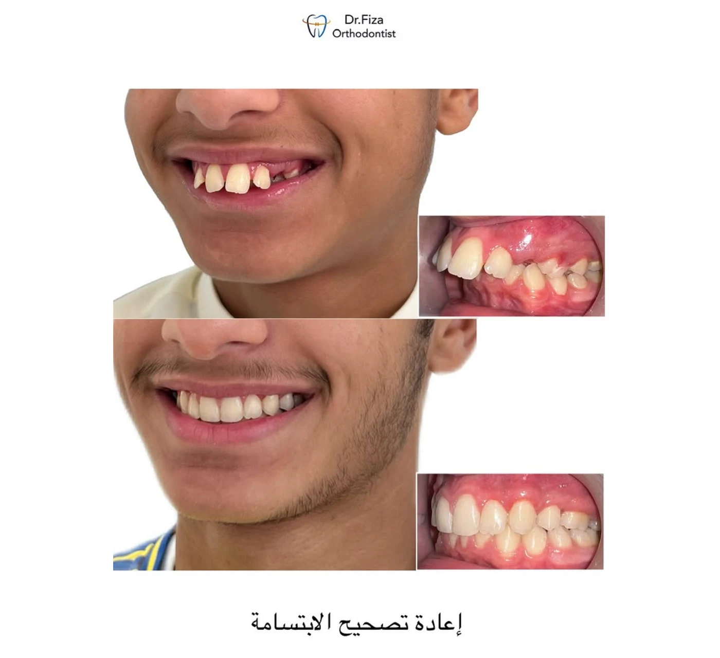 Orthodontic before and after by Dr. Fiza Quadri in Kuwait: bite correction