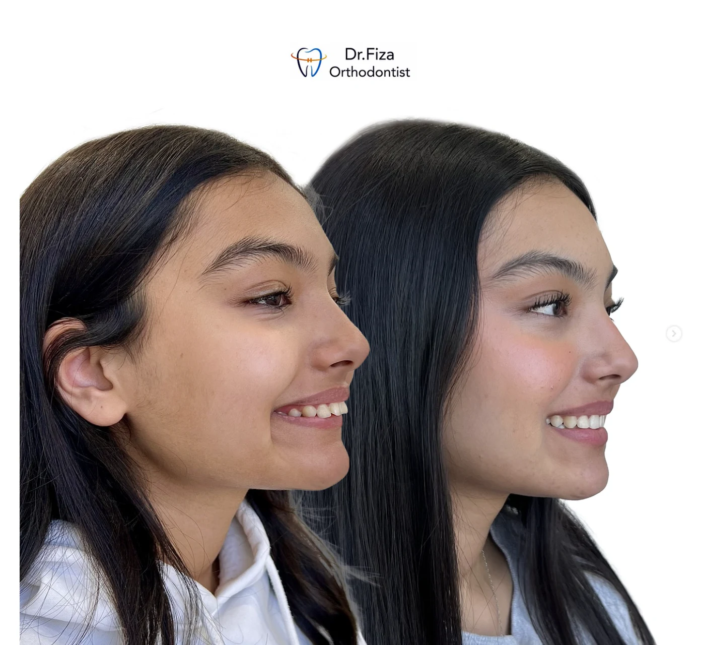 Orthodontic before and after by Dr. Fiza Quadri in Kuwait: smile line, profile view