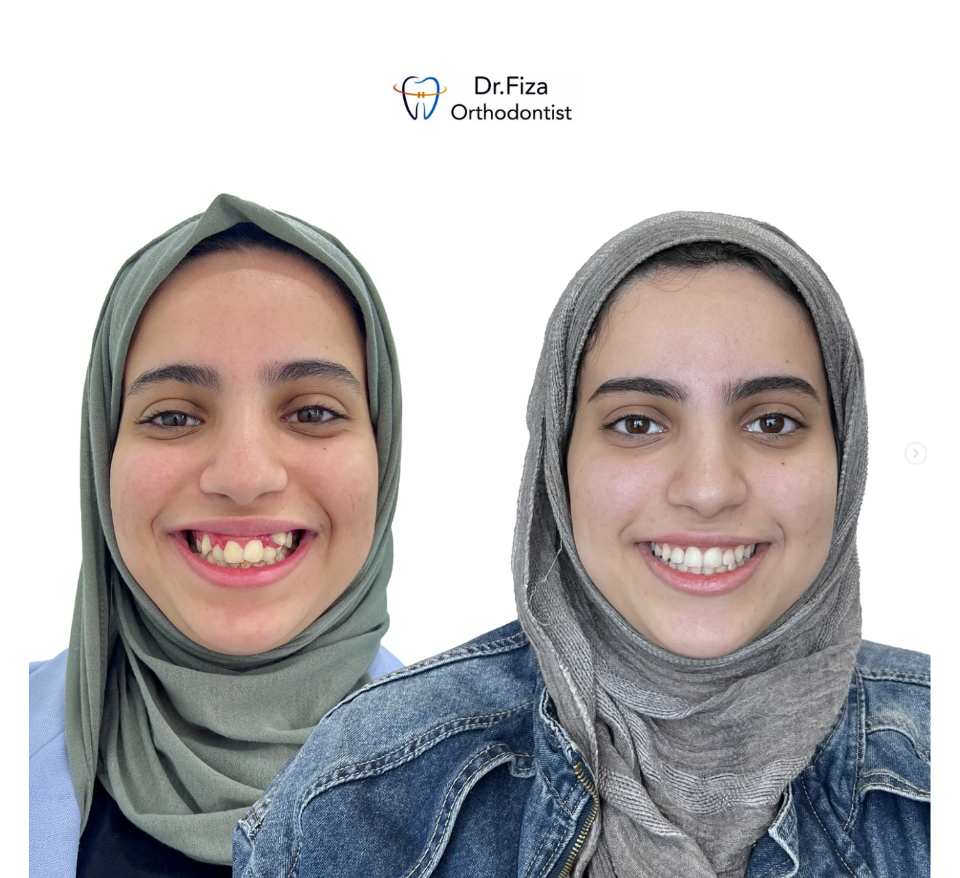 Orthodontic before and after by Dr. Fiza Quadri in Kuwait: spacing and protrusion