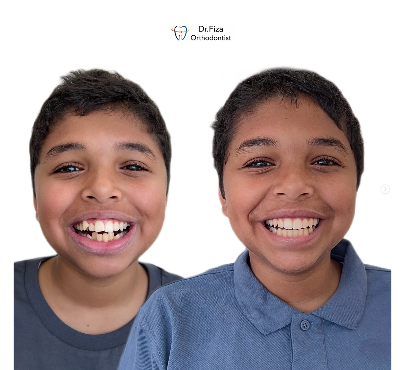 Orthodontic before and after by Dr. Fiza Quadri in Kuwait: crowded, malaligned teeth associated with protrusion