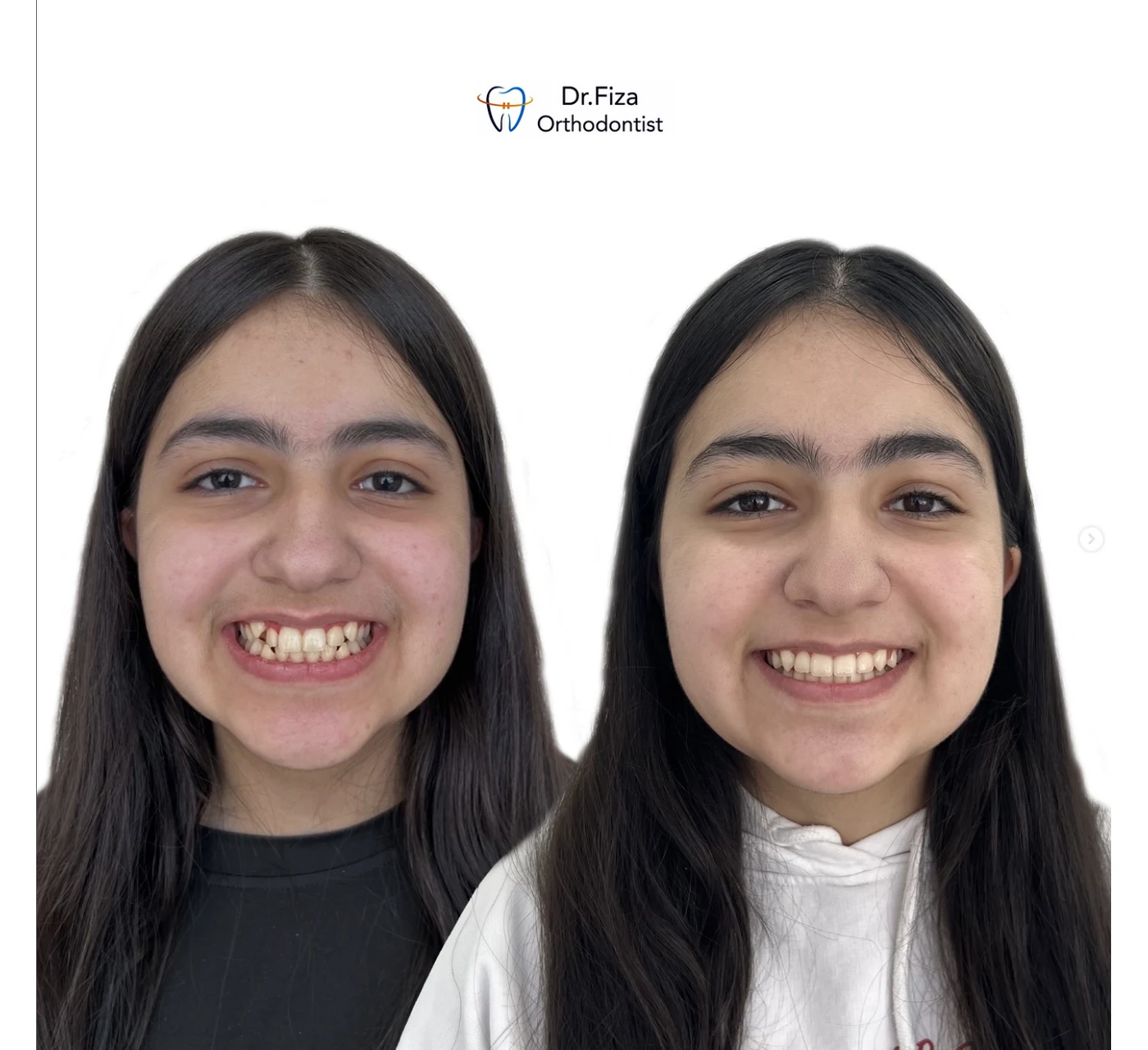 Orthodontic before and after by Dr. Fiza Quadri in Kuwait: upper and lower crowding