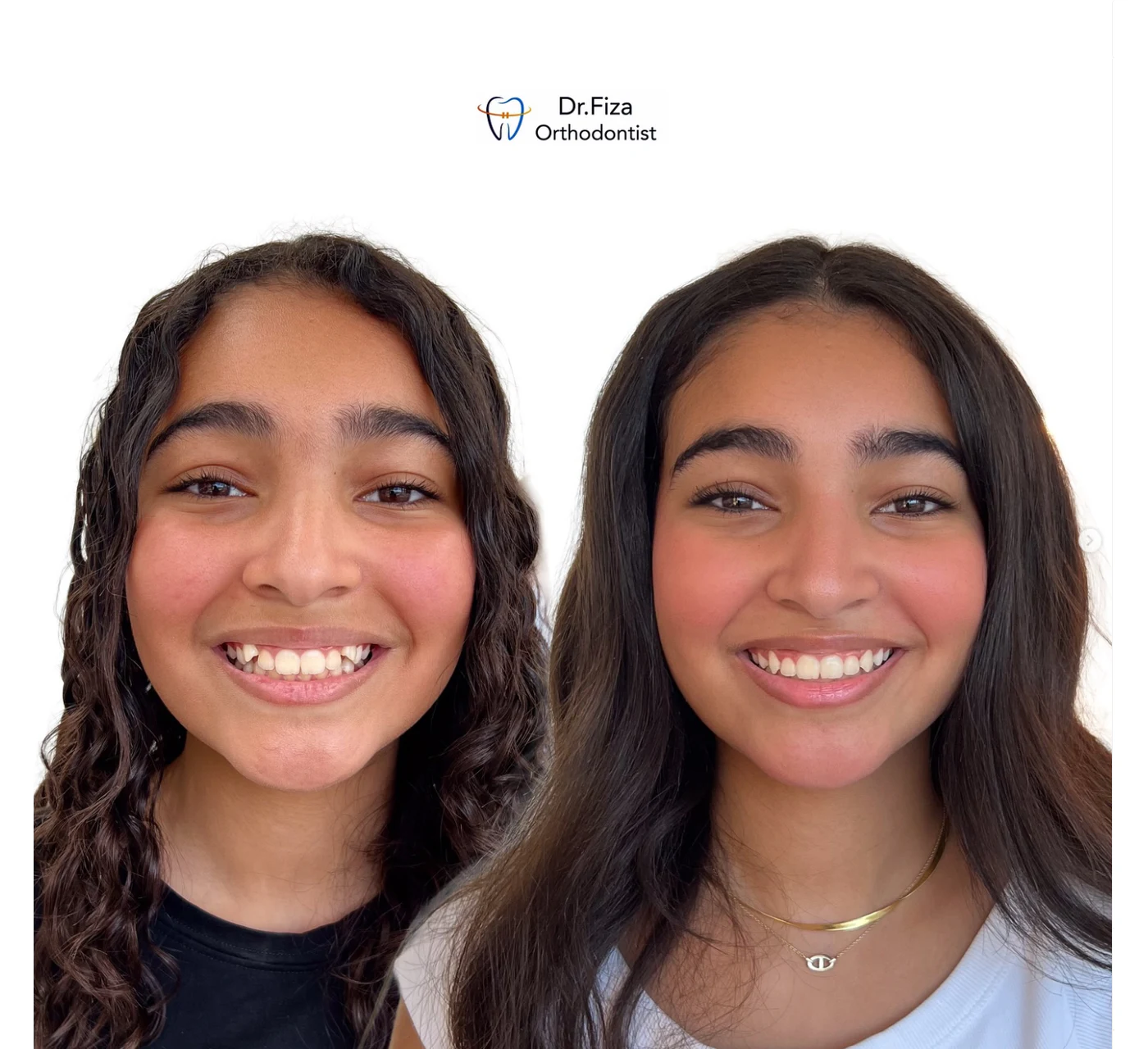 Orthodontic before and after by Dr. Fiza Quadri in Kuwait: uneven front teeth