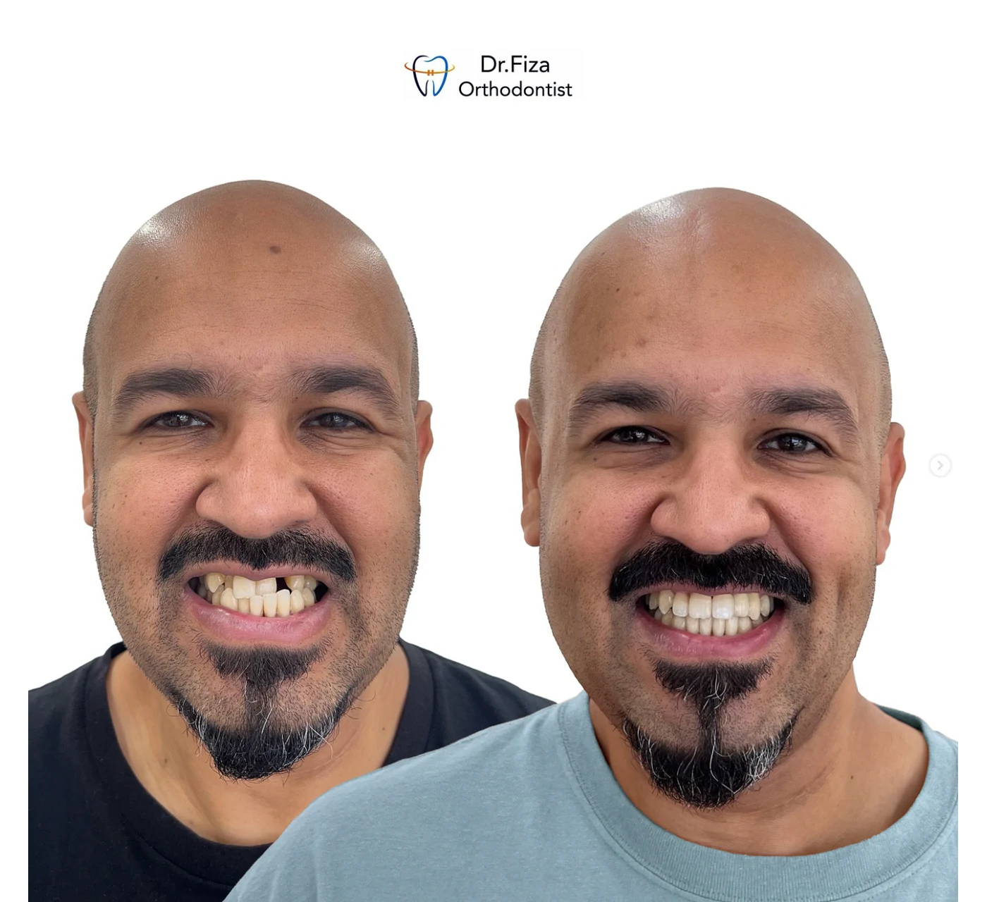 Orthodontic before and after by Dr. Fiza Quadri in Kuwait: adult orthodontic treatment