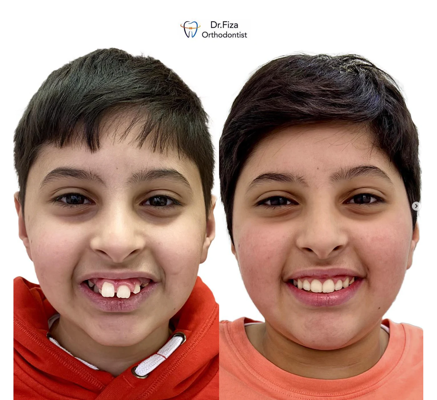 Orthodontic before and after by Dr. Fiza Quadri in Kuwait: severe protrusion (forwardly placed bunny teeth) associated with deepbite